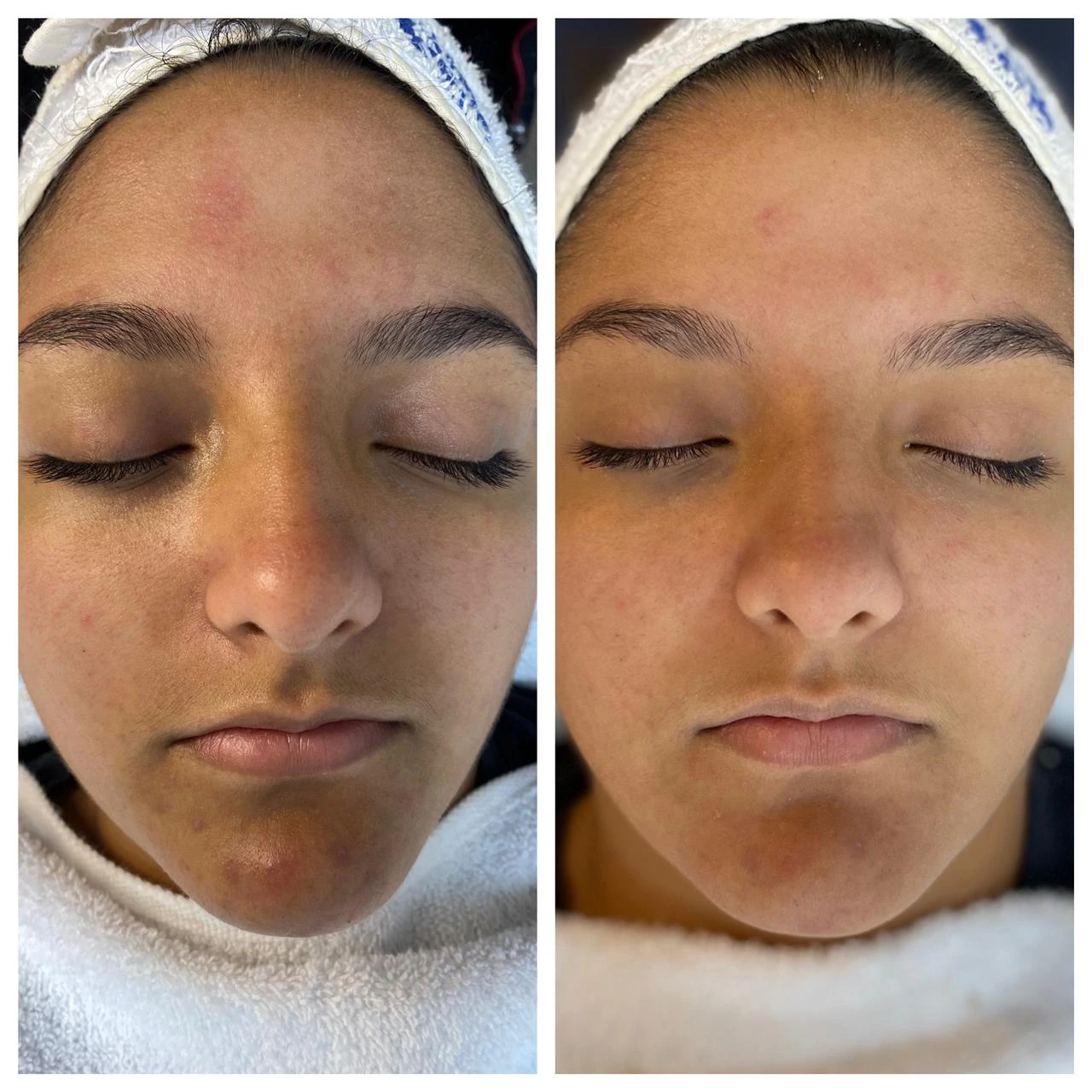 Caso de éxito en despigmentación 1