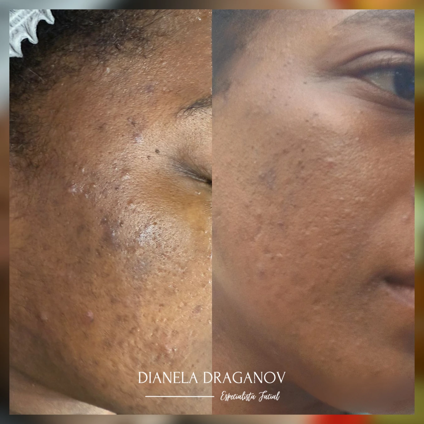 Caso de éxito en despigmentación 10