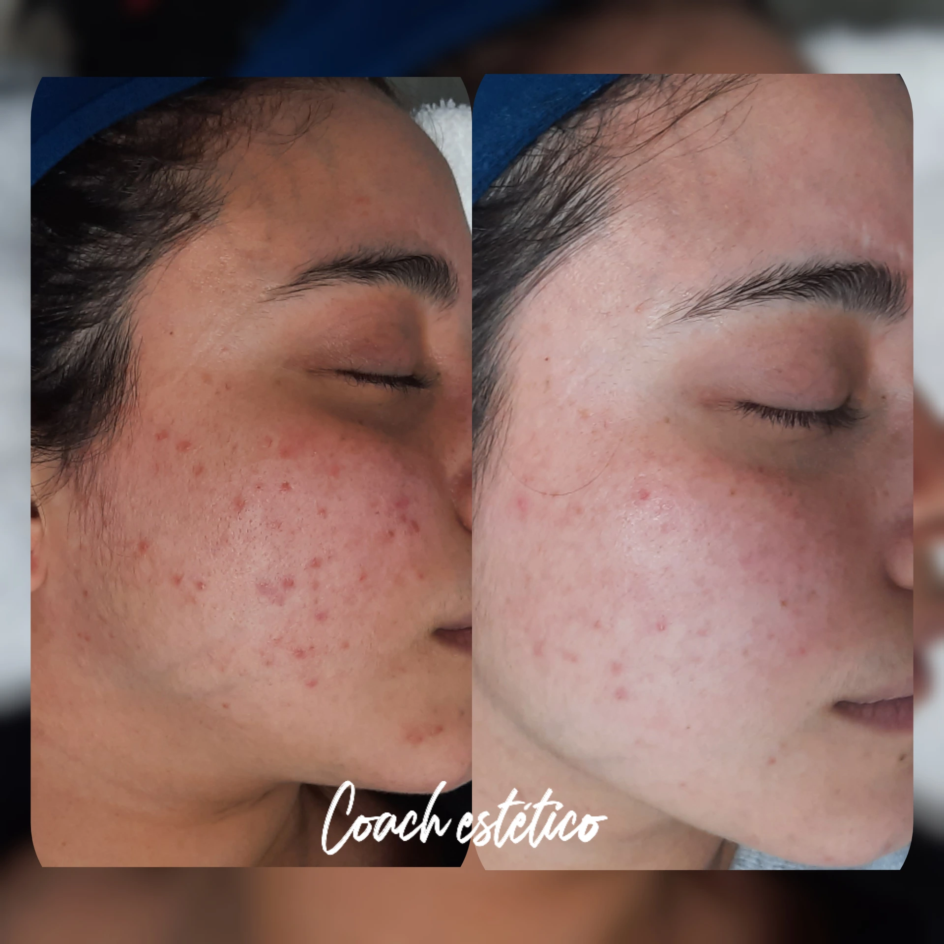 Caso de éxito en despigmentación 2