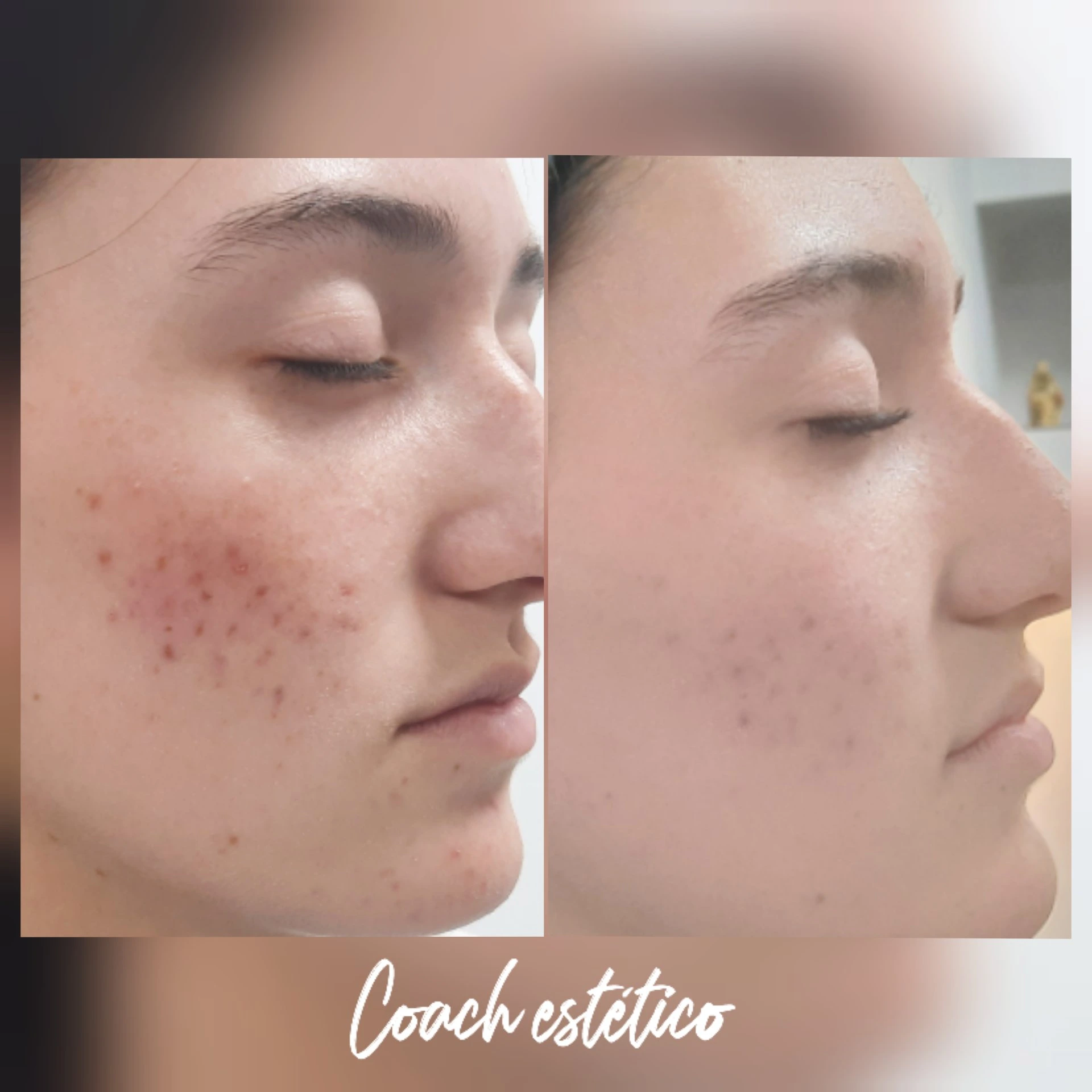 Caso de éxito en despigmentación 3