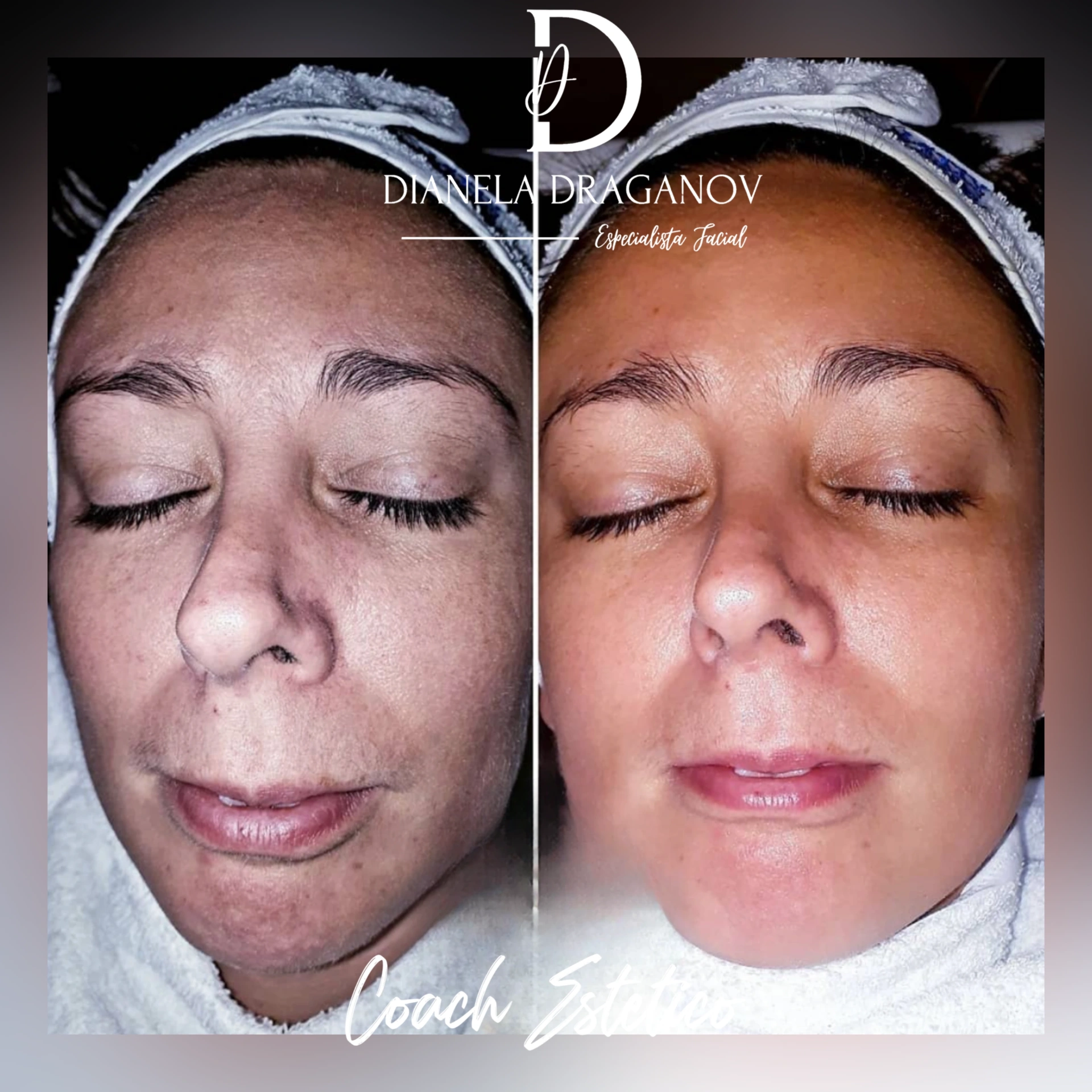 Caso de éxito en despigmentación 4