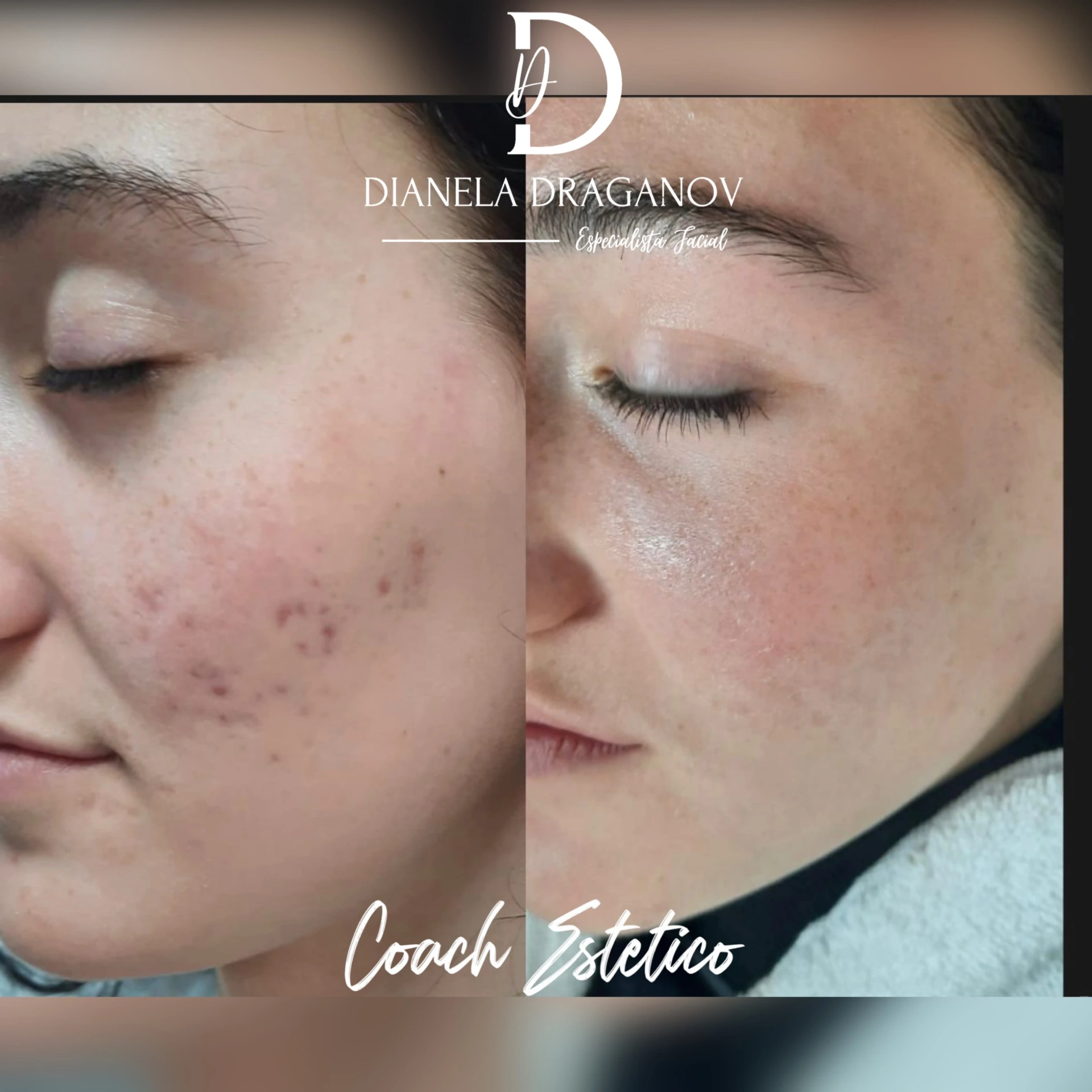 Caso de éxito en despigmentación 5