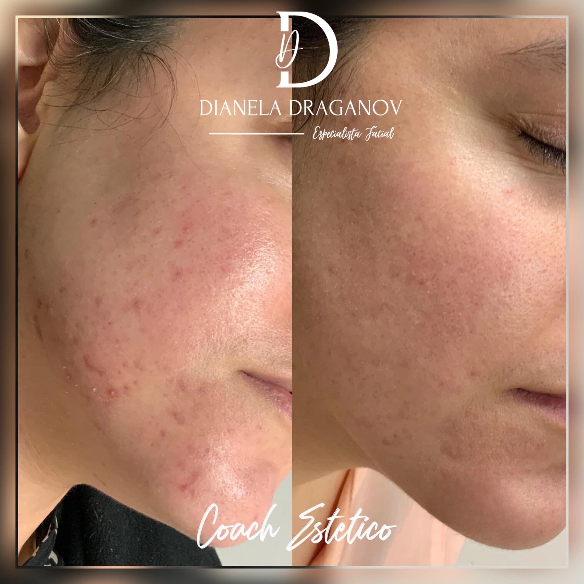 Caso de éxito en despigmentación 6