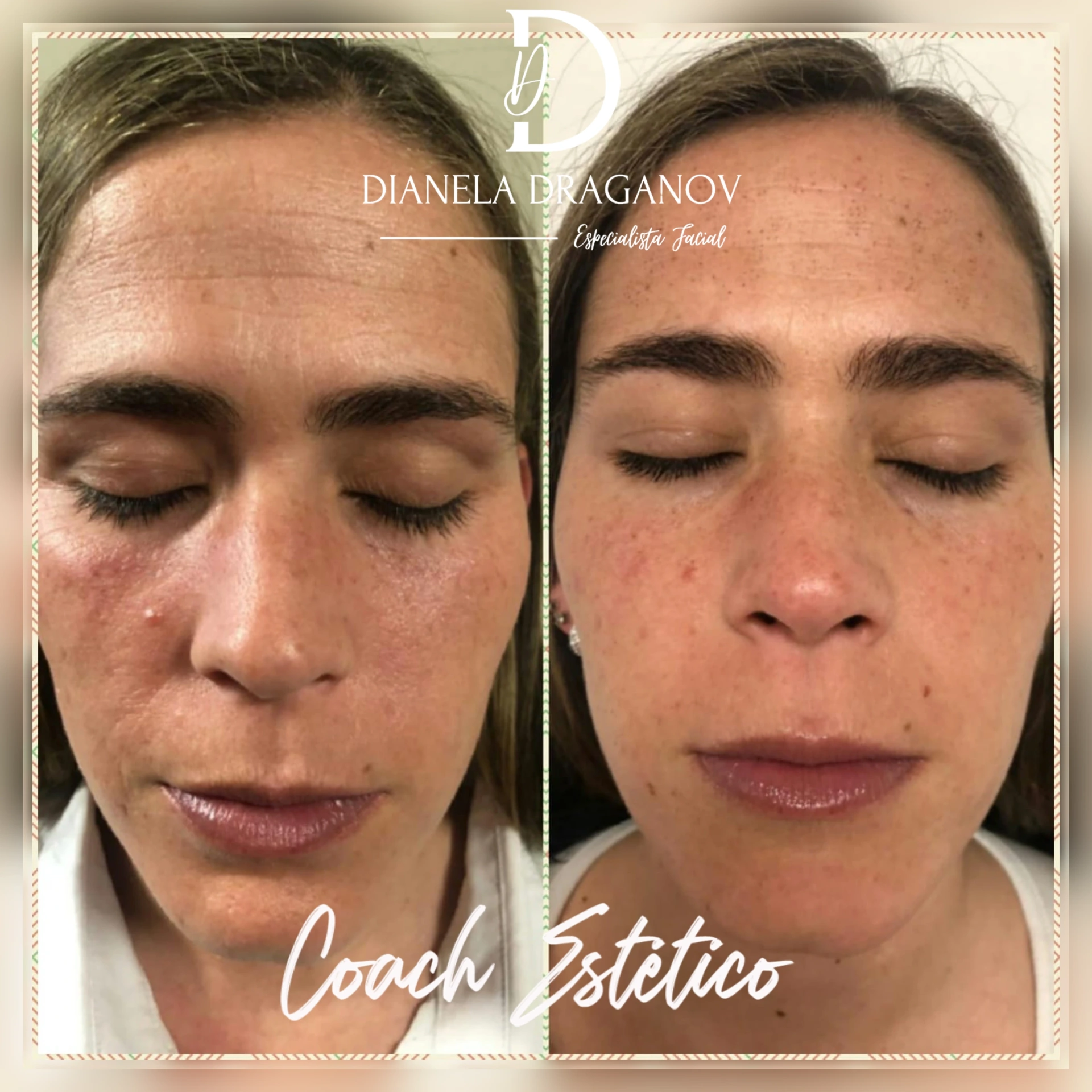 Caso de éxito en despigmentación 7