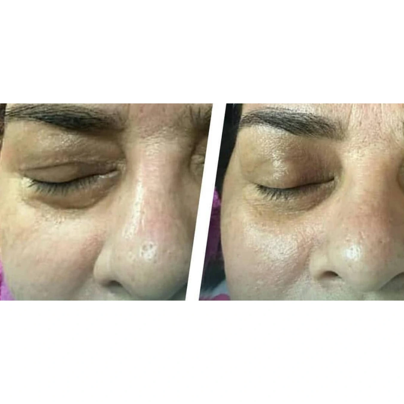 Caso de éxito en despigmentación 8