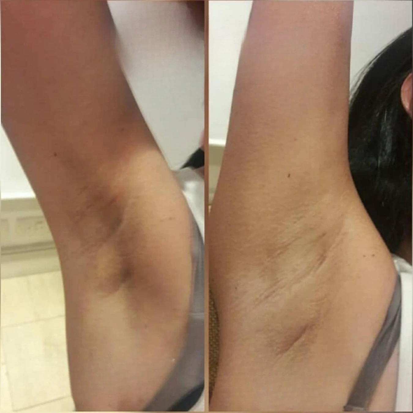 Caso de éxito en despigmentación 9