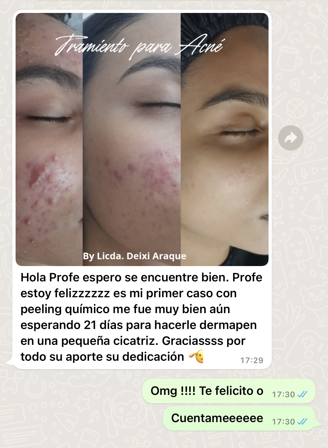 Testimonio de alumna sobre tratamiento para acné con peeling químico